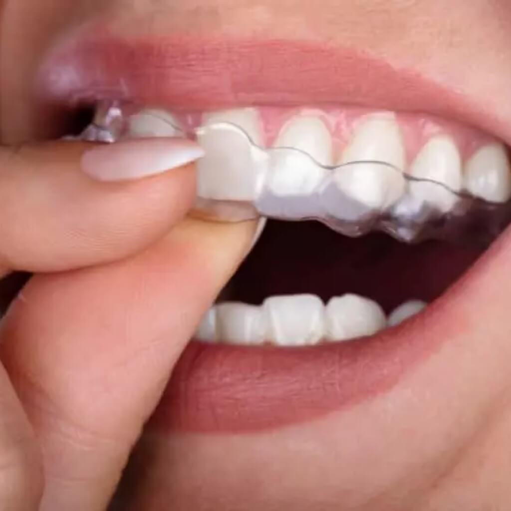 Invisalign Brickell 5