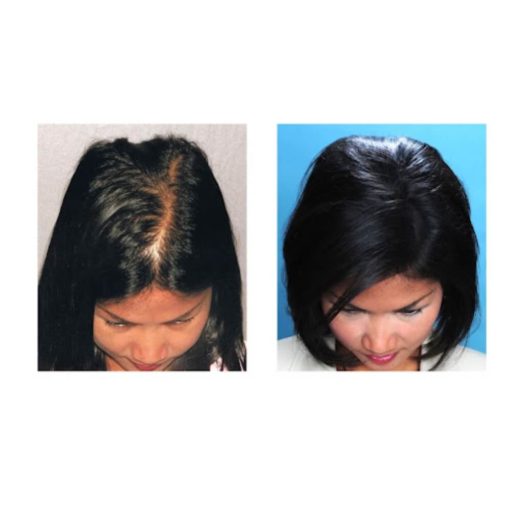 Cirugía Bosley - Hair Restoration & Transplant - Miami