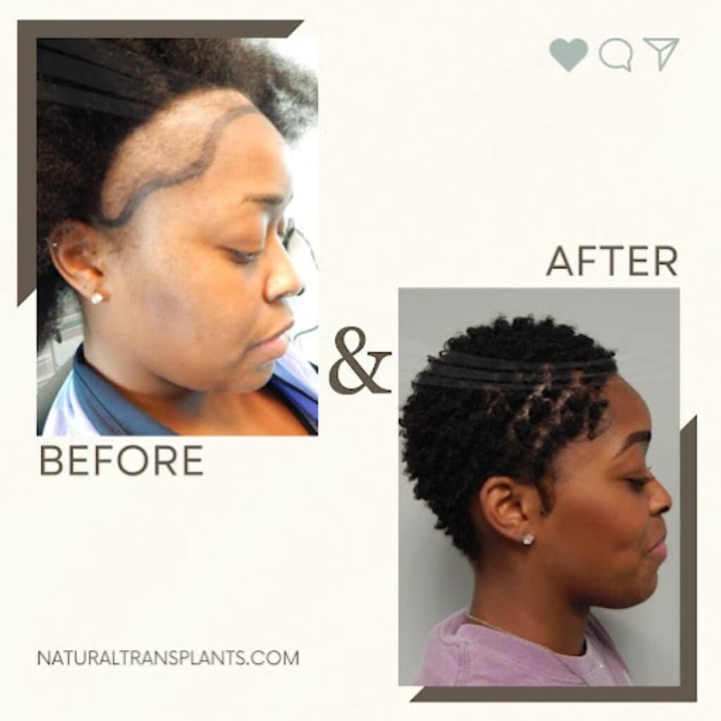 Cirugía Natural Transplants