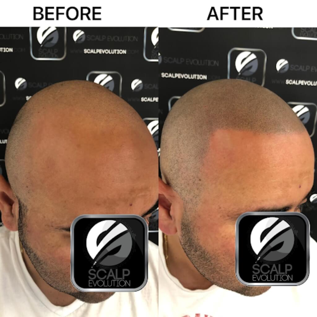 Cirugía Scalp Evolution