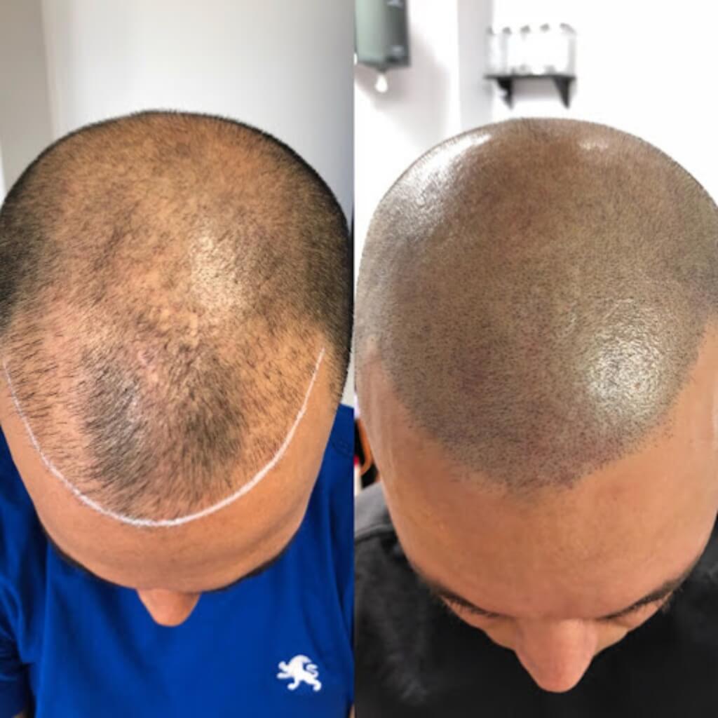 Médicos Scalp Evolution