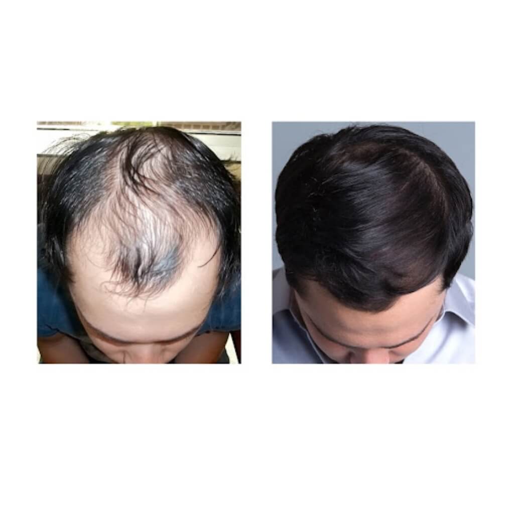 Procedimiento Bosley - Hair Restoration & Transplant - Miami
