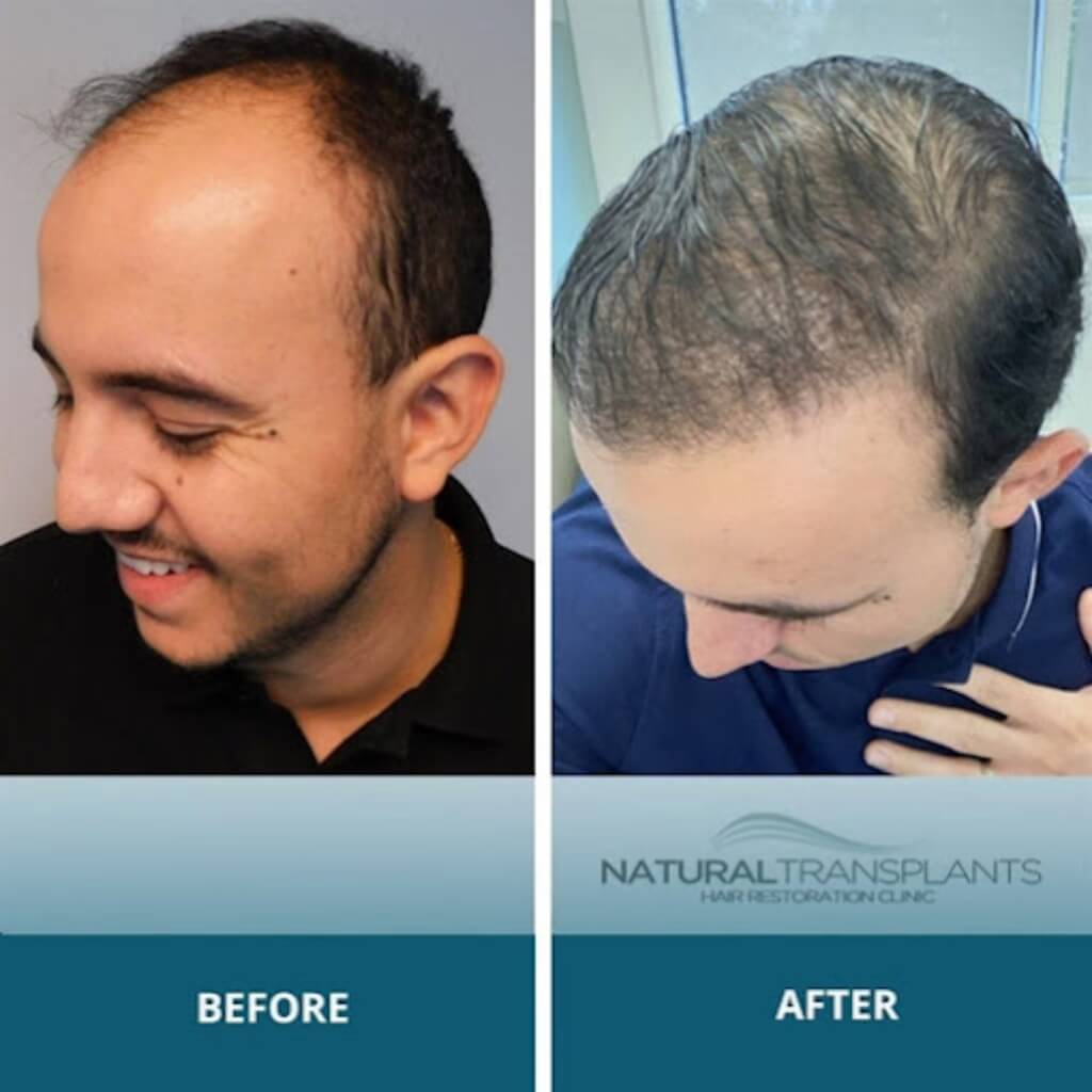 Procedimiento Natural Transplants