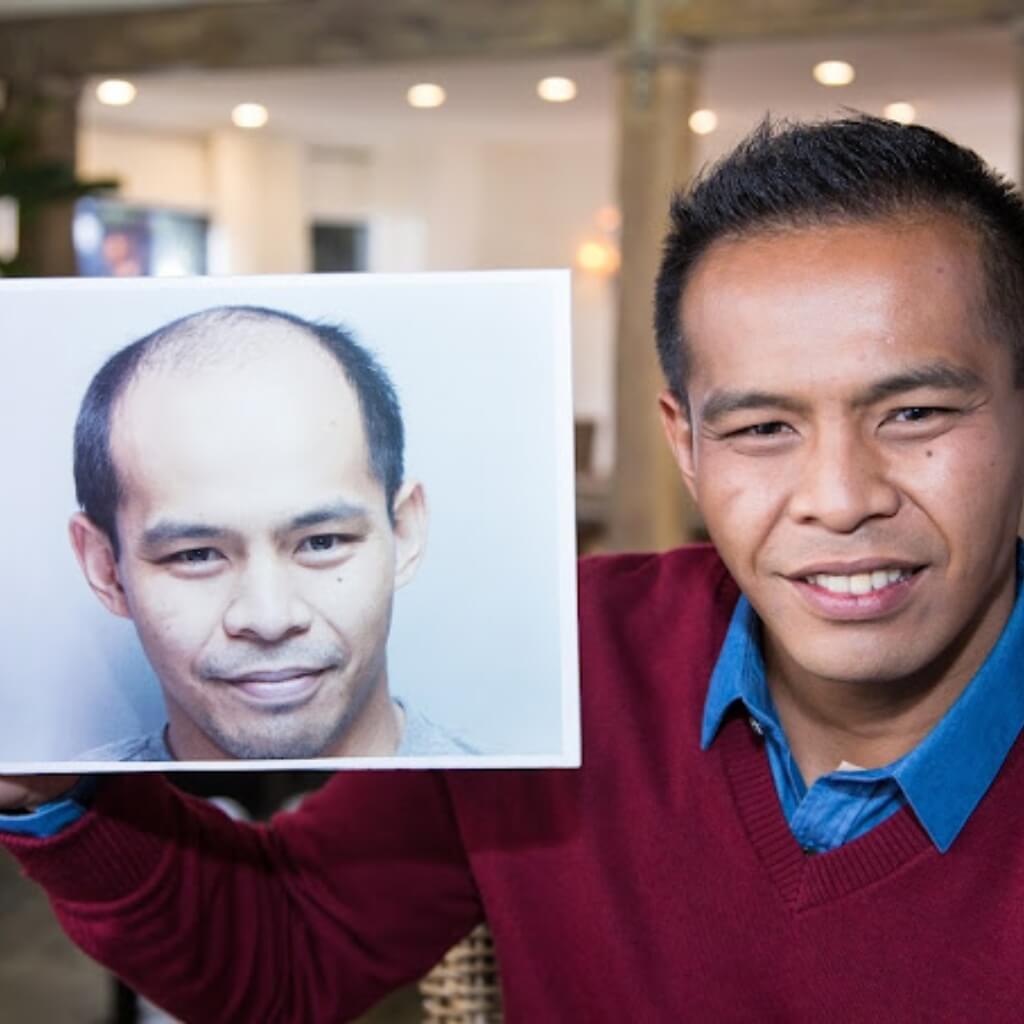 Tratamiento Bosley - Hair Restoration & Transplant - Miami