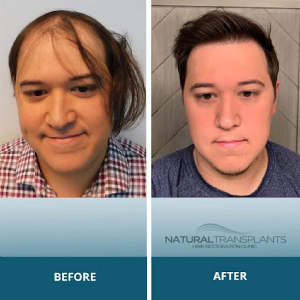 Tratamiento Natural Transplants