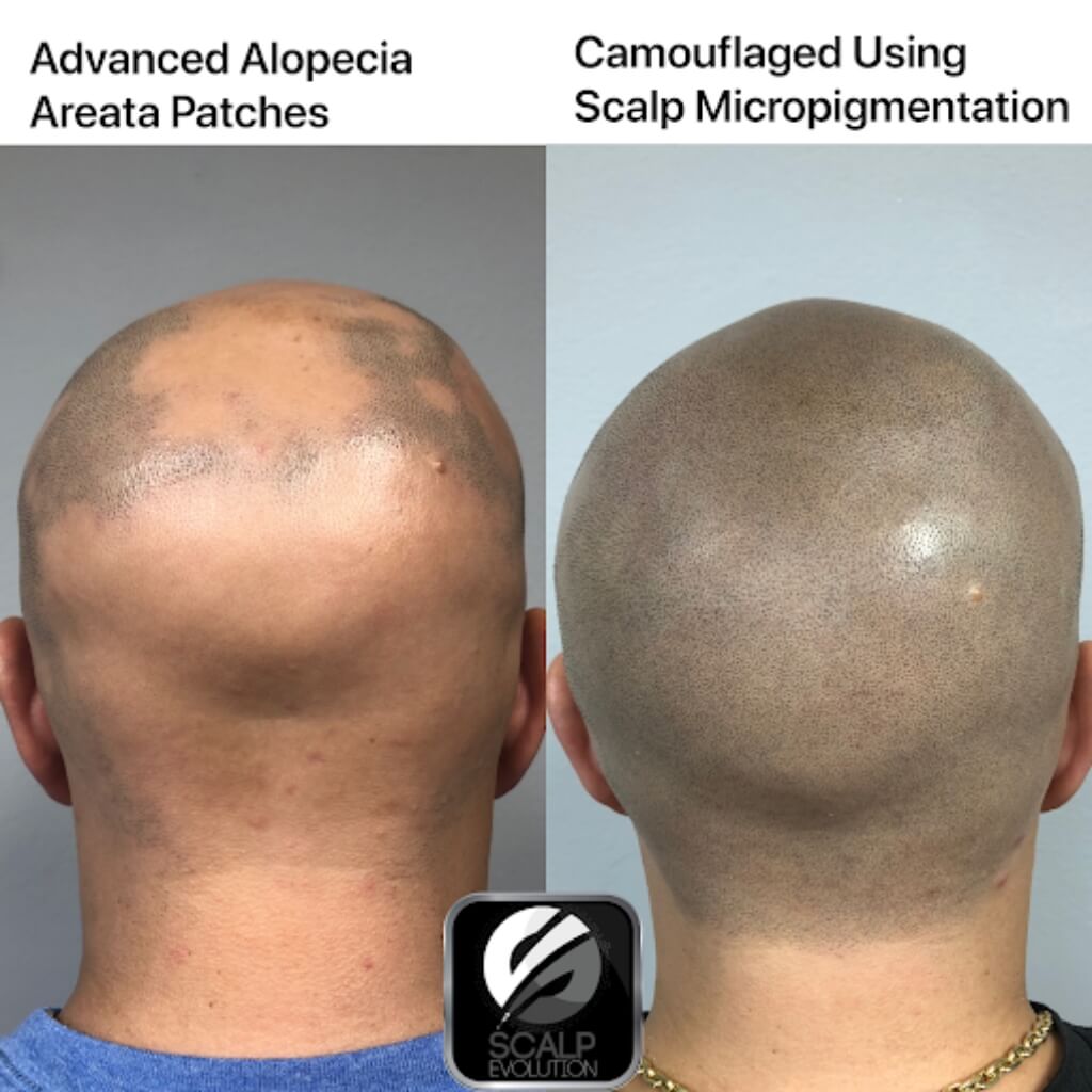 Tratamiento Scalp Evolution